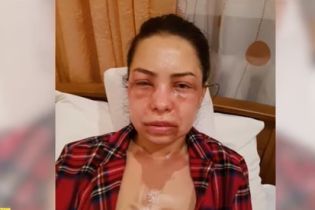 Лікарі рятують зір дружини французького режисера, яку у Дніпрі облили кислотою