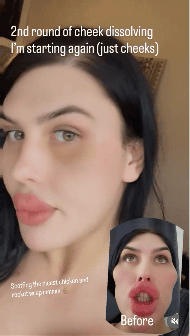 Софія Ліпс після розчинення філерів на обличчі і до цього / © TikTok-акаунт Софії Ліпс