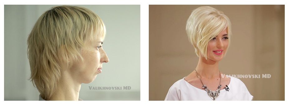 Ринопластика, до і після