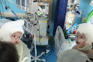 Что ждет сиамских близняшек из Черновцов: примеры успешных операций в мире