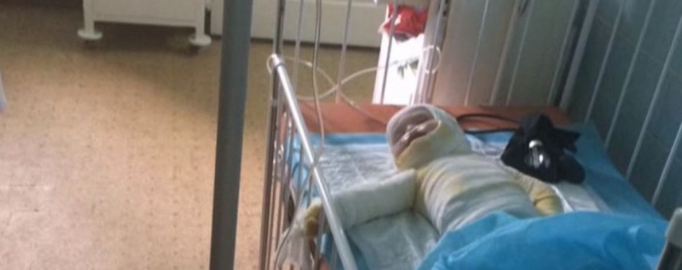 В Одессе умерла 2-летняя девочка, которую родители обварили кипятком и две недели сами лечили