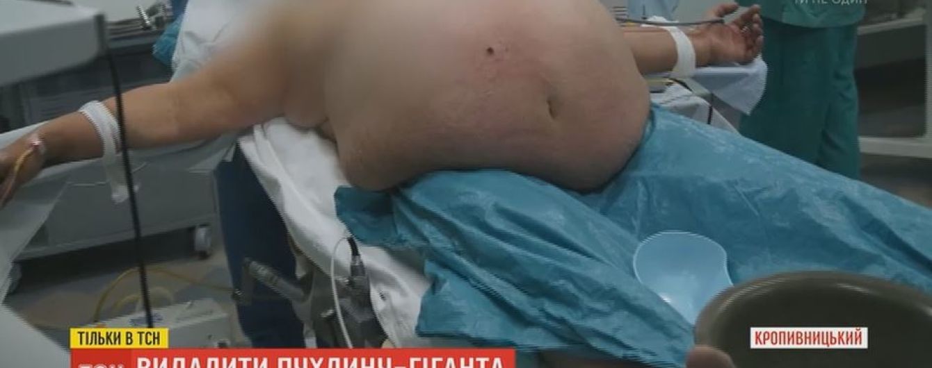 17-кілограмову пухлину видалили пацієнтці в Кропивницькому