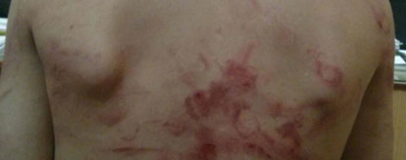 Била так, що все тіло червоне. У Вінниці жінці загрожує ув'язнення за побиття 7-річного сина