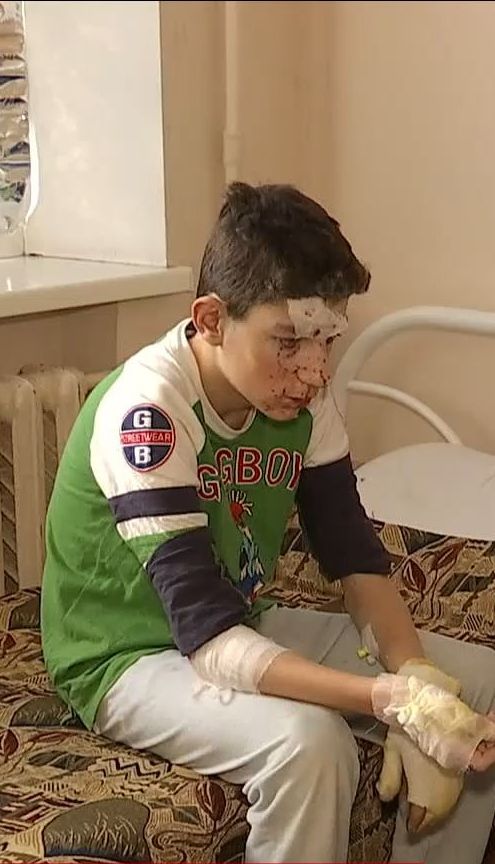 В Никополе двое подростков пострадали от взрыва петарды