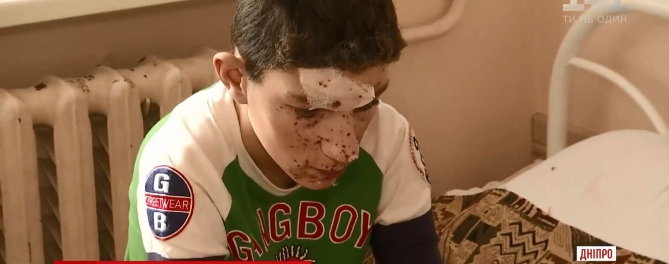 В Никополе дети получили тяжелые травмы от петарды, которую нашли на помойке