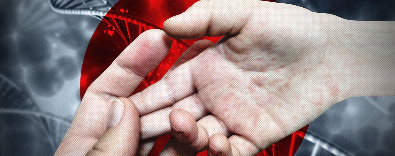 Первый случай в городе: в Киеве от кори умер человек