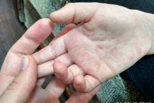 В Україні зростає кількість хворих на кір: лідирує Вінниччина