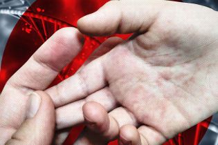 В Николаеве вспышка кори в школе-интернате - госпитализированы уже 13 человек