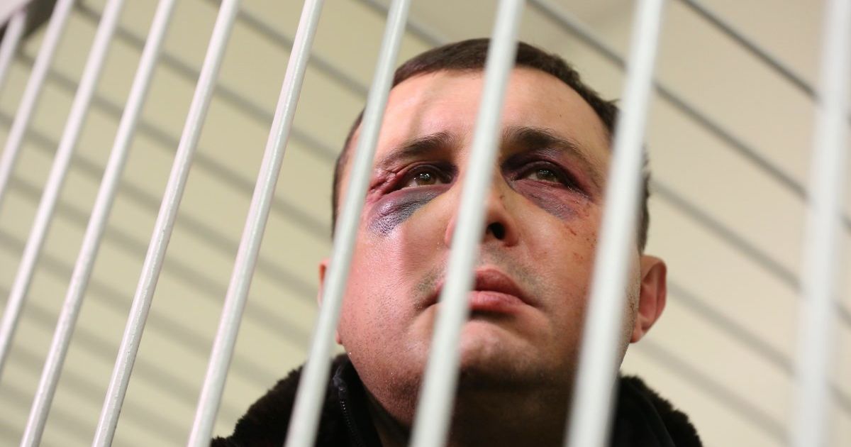 "Явно не вчерашние". В СБУ прокомментировали синяки на лице экс-нардепа Шепелева