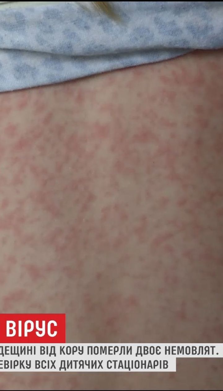 Всі дитячі стаціонари Одещини перевірять на наявність кору