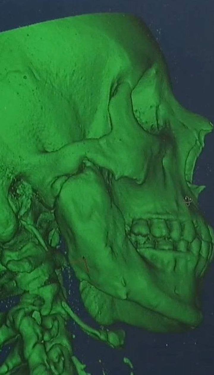 Технологии 3D-печати в медицине. Как на специальных принтерах изготавливают части лица
