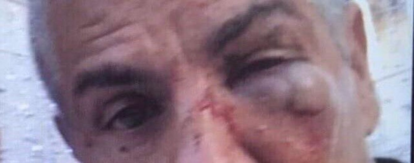 Зірка "Таксі" Насері може втратити зір після бійки у московському барі