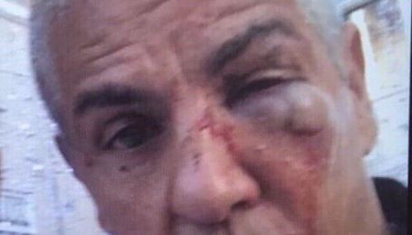 Зірка "Таксі" Насері може втратити зір після бійки у московському барі