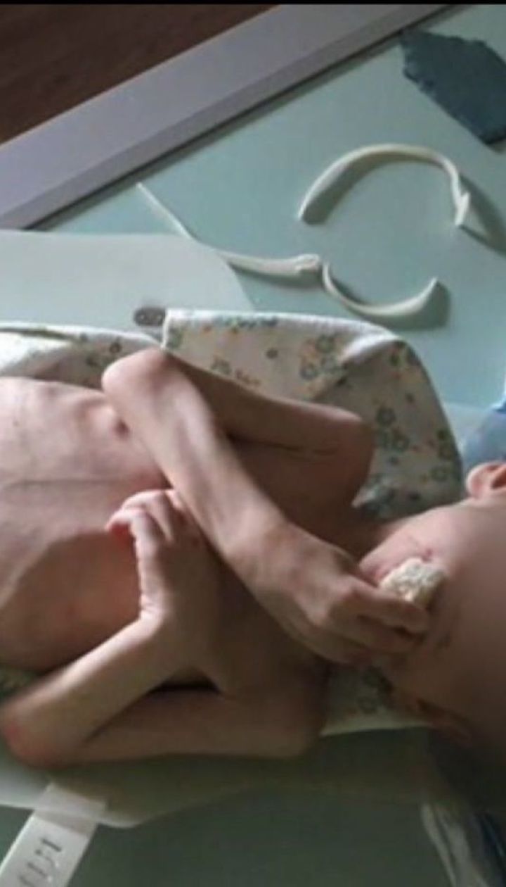 На Кіровоградщині із сім‘ї депутата райради забрали виснажене голодом дитя
