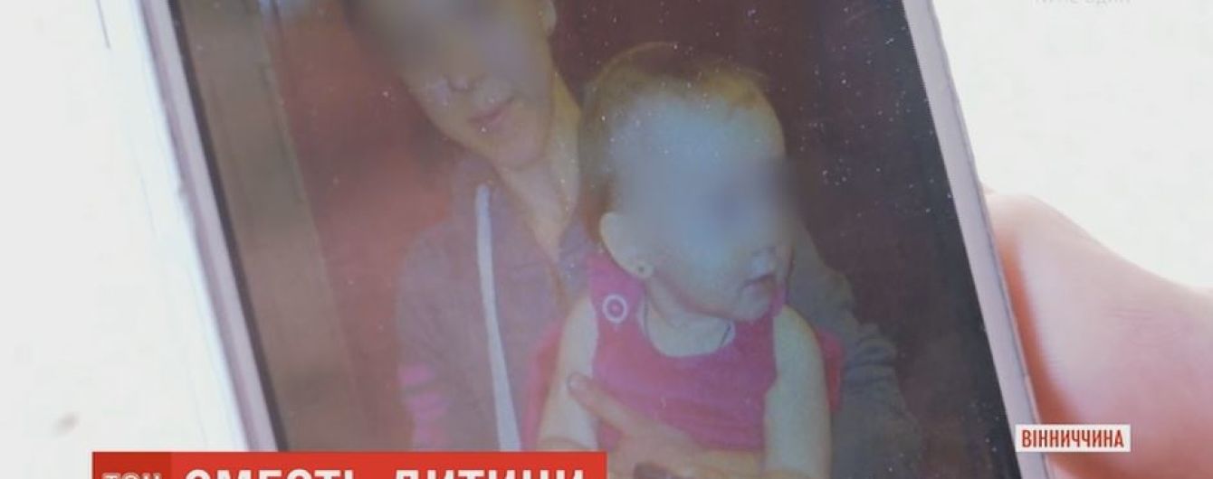 На Вінниччині померла дитина, яку від опіку вдома лікували марганцівкою