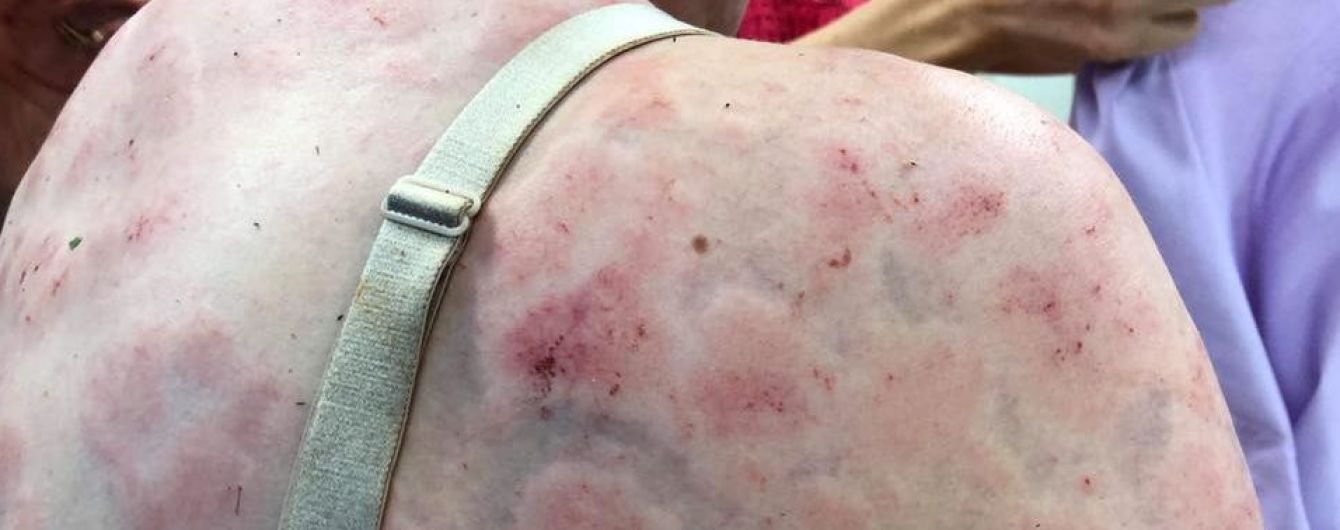 Прятала от ударов дитя. Героическая австралийка показала изуродованное страшным градом тело и лицо