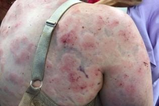 Прятала от ударов дитя. Героическая австралийка показала изуродованное страшным градом тело и лицо