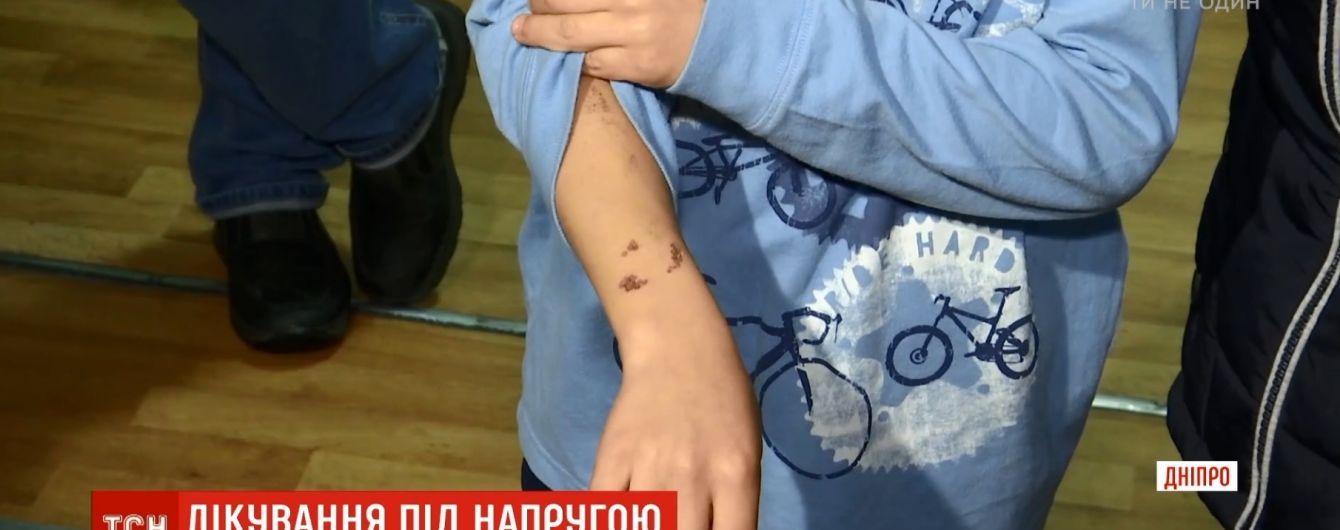 У Дніпрі школяр отримав опік на процедурах у стоматологічній поліклініці