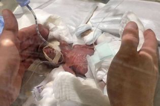 Японські лікарі врятували немовля, яке народилося з вагою у 268 грамів