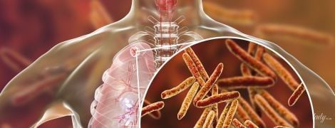 Палочка Коха vs человечество: убьет ли нас туберкулез