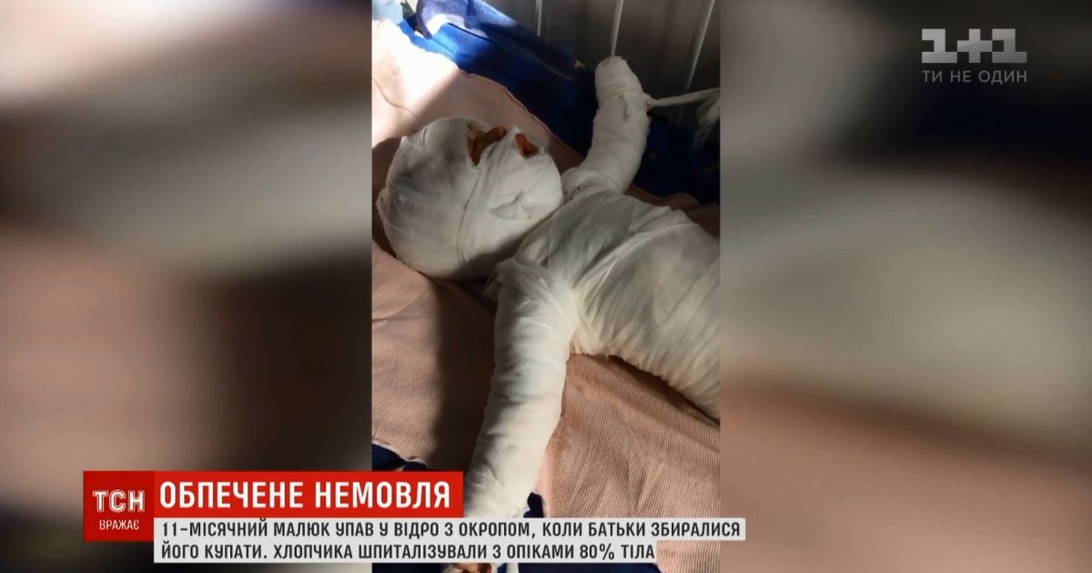 На Одещині немовля впало у відро з окропом