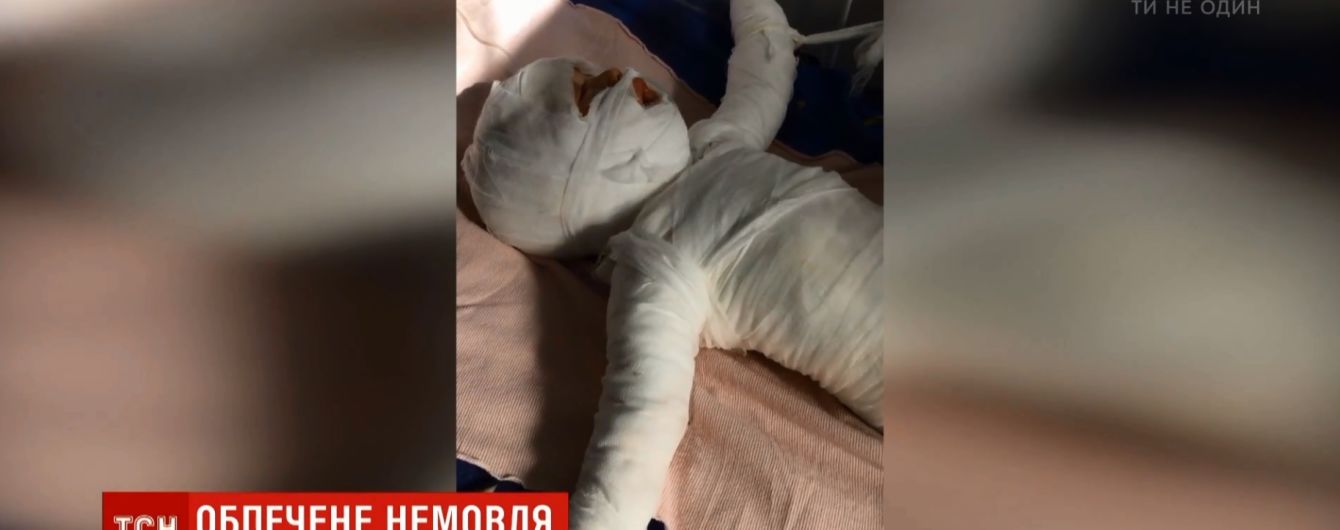 В Одесской области младенец упал в ведро с кипятком