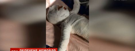 На Одещині немовля впало у відро з окропом