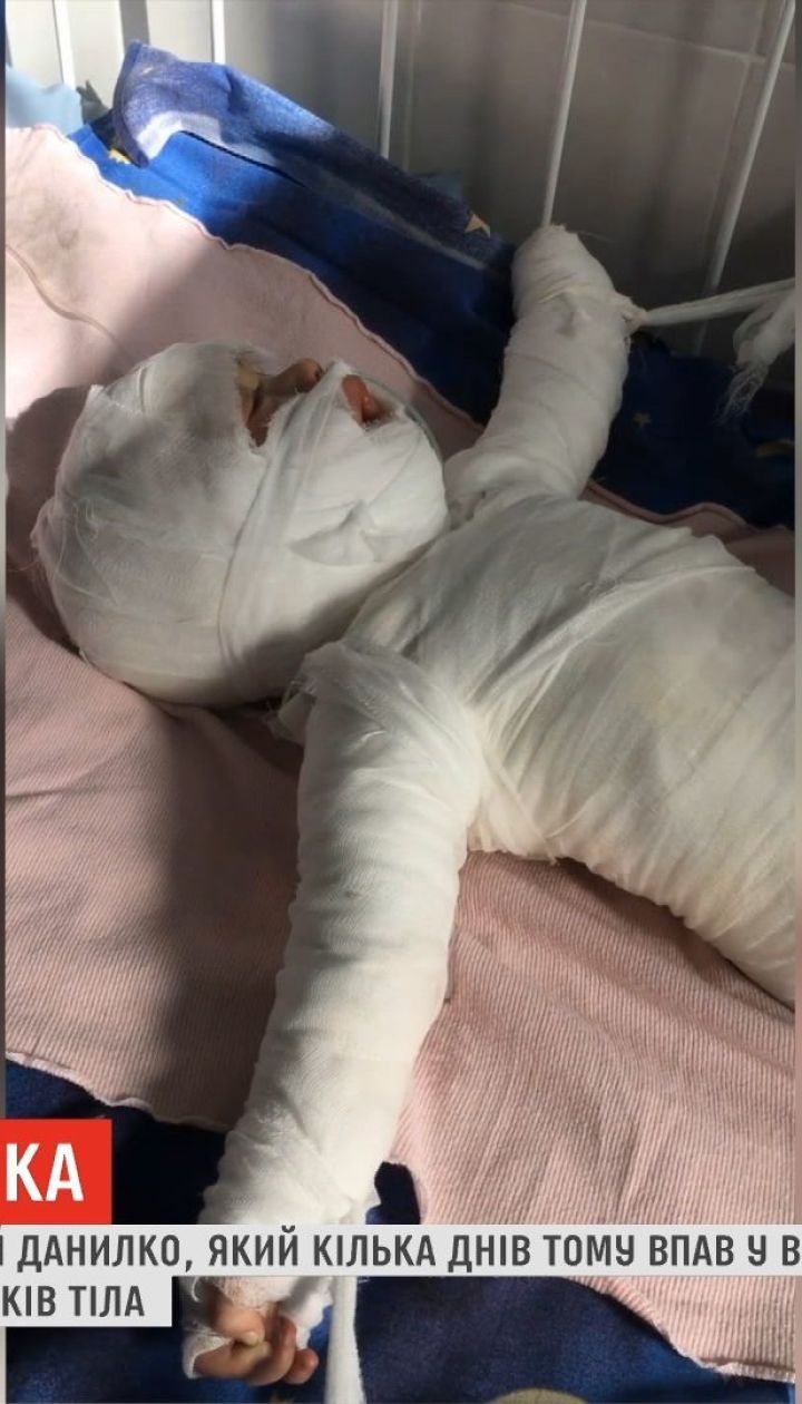 В одесской больнице умер маленький Даня, который упал в ведро с кипятком