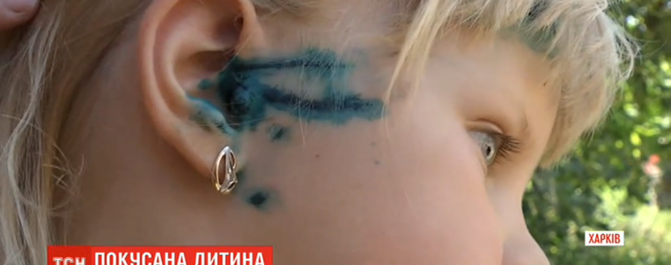 На Харківщині пес напав на 5-річну дитину: покусав обличчя