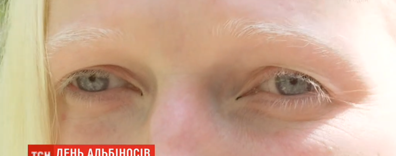 Поцелованные Богом люди: как живется альбиносам в Украине