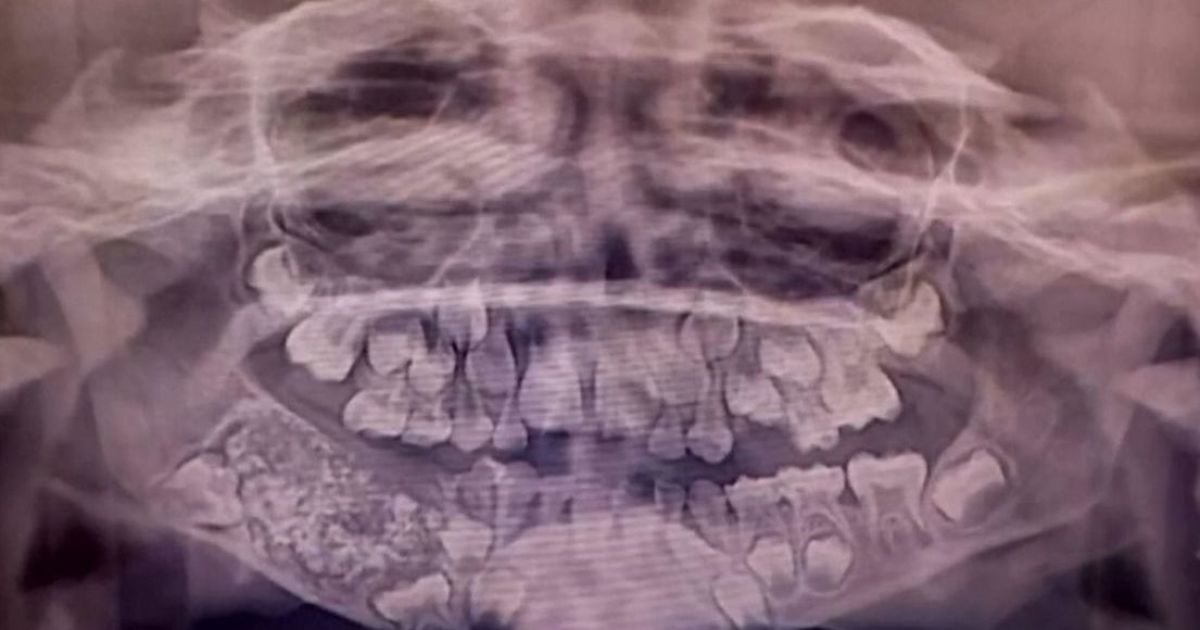 В Індії у семирічного хлопчика знайшли 526 зайвих зубів