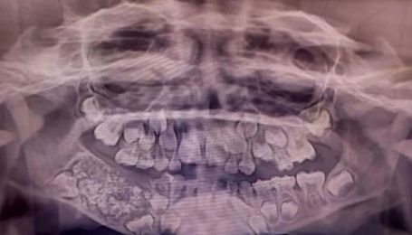 В Індії у семирічного хлопчика знайшли 526 зайвих зубів