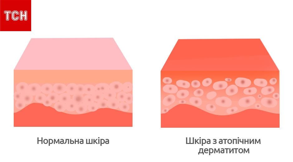 Атопічний дерматит, для блогів