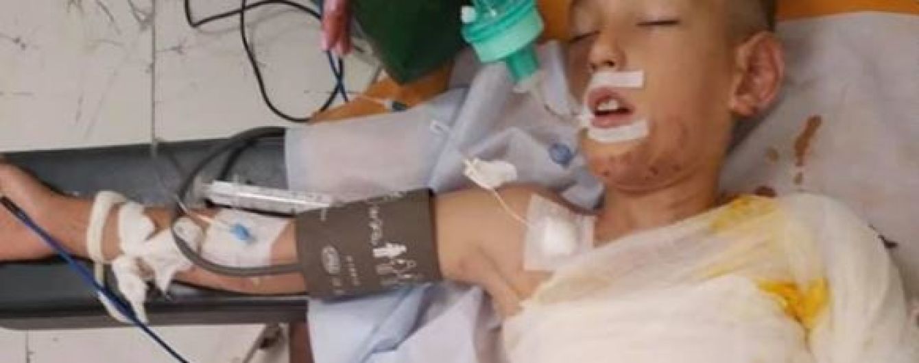 У Дніпрі діти під час гри підпалили 8-річного хлопчика