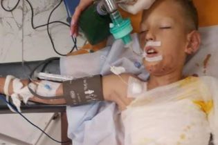 У Дніпрі діти під час гри підпалили 8-річного хлопчика