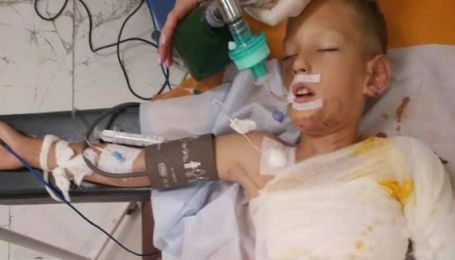 У Дніпрі діти під час гри підпалили 8-річного хлопчика