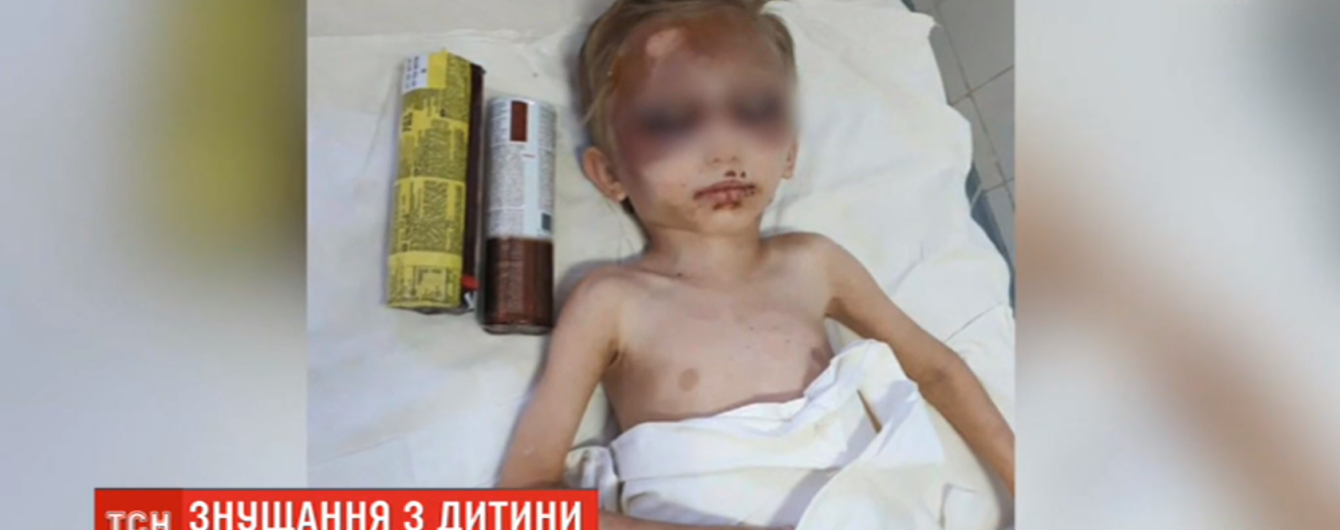 Ребенок едва выжил после пыток названной матери. Она била, колола иглами и морила голодом мальчика