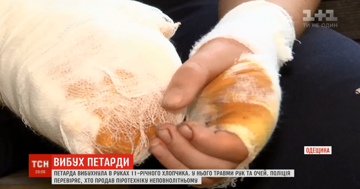 В Одесской области от взрыва петарды 11-летнему мальчику разорвало пальцы на руках и повредило глаза