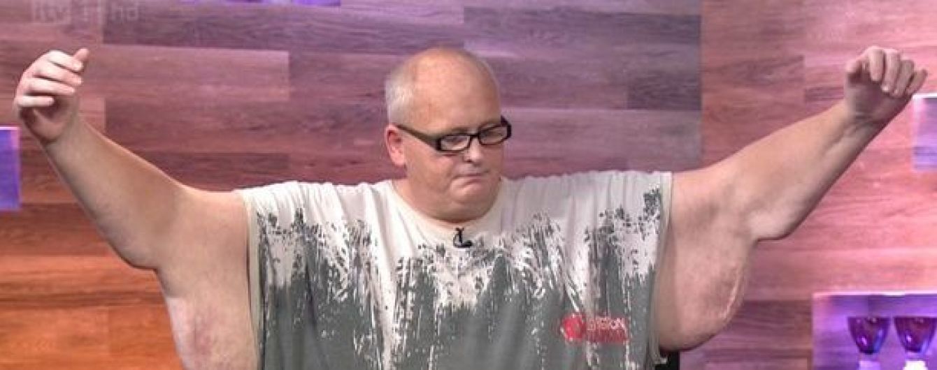 Последний шанс: 200-килограммовый британец просит денег на операцию у государства