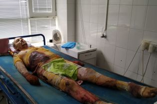 Пожар едва не забрал жизни Ивана, но мужчина балансирует на грани