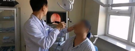 Китайські лікарі видалили врослий у ніс чоловіка зуб