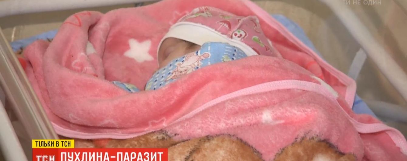 Столичні лікарі видалили новонародженій дівчинці пухлину, яка важила майже половину дитини