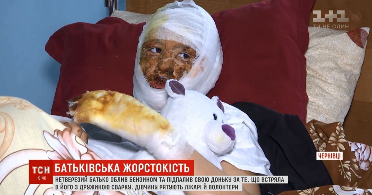 П’яний чоловік у Чернівцях підпалив власну доньку під час сварки з дружиною