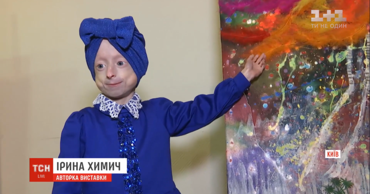 Українські лікарі зробили унікальну операцію 10-річній Іринці Химич, яка хворіє на прогерію
