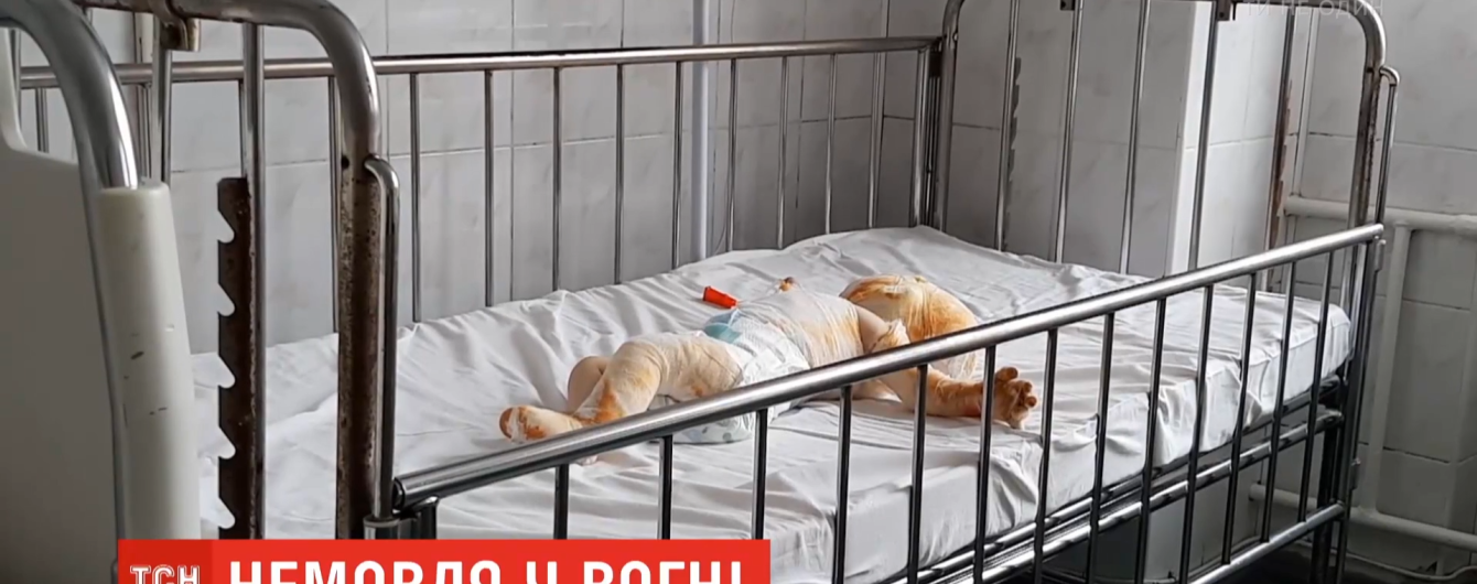 3-річний брат підпалив ковдру: у Рівненській області 8-місячне немовля зазнало тяжких опіків