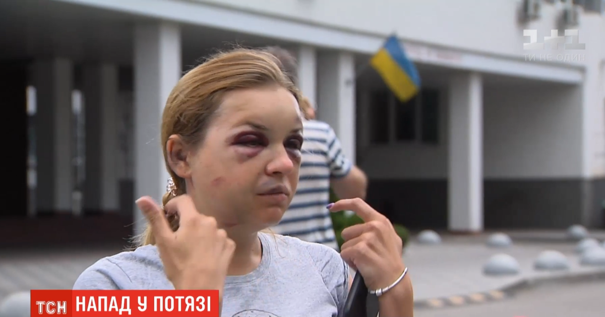 Струс мозку, перелом щелепи, численні гематоми: потерпіла від нападу у поїзді "Маріуполь-Київ" розповіла нові подробиці