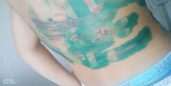 укус собаки дитина