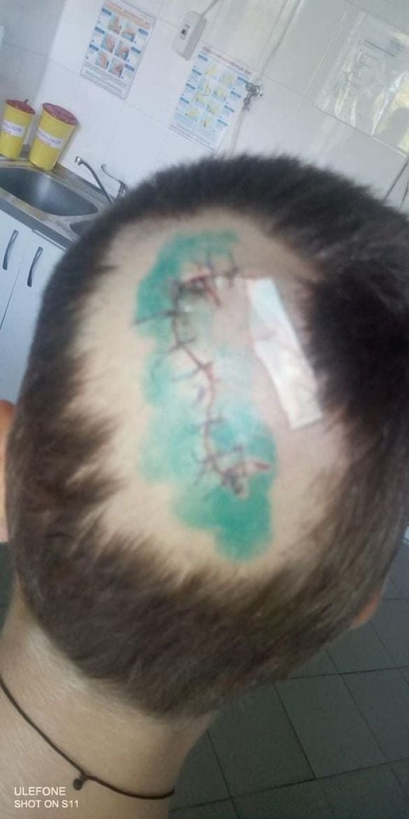 укус собаки дитина