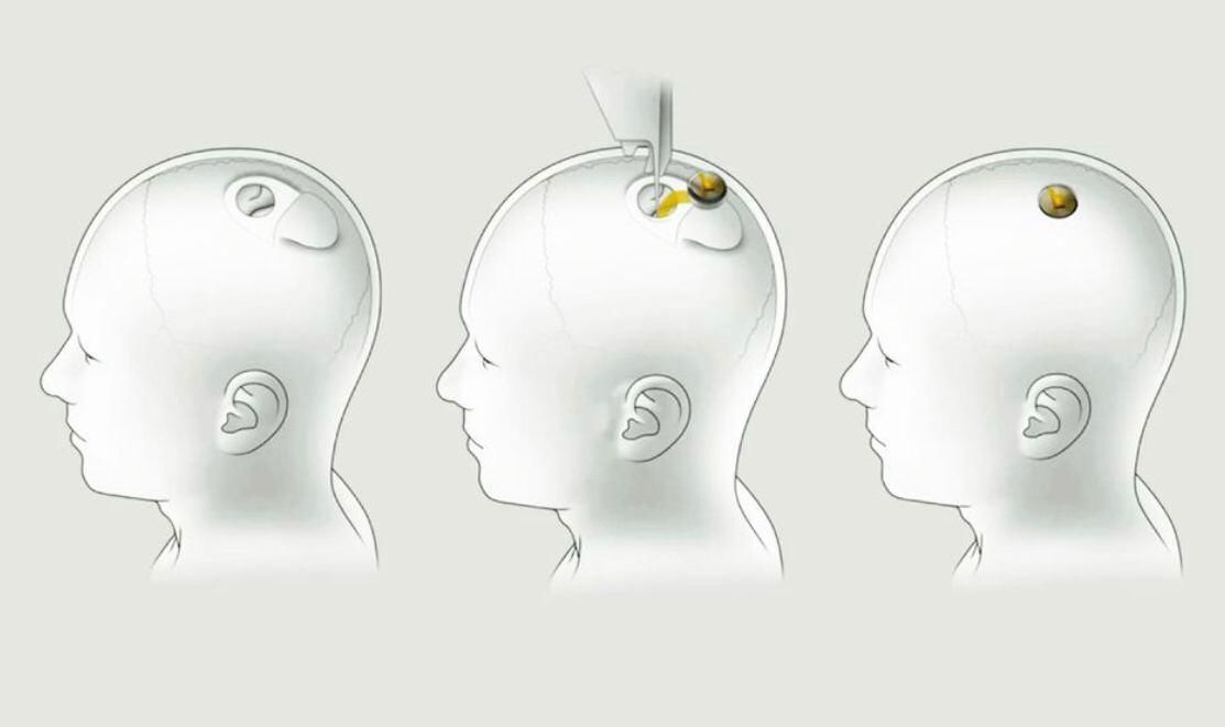 Вигляд нейроінтерфейсу Neuralink