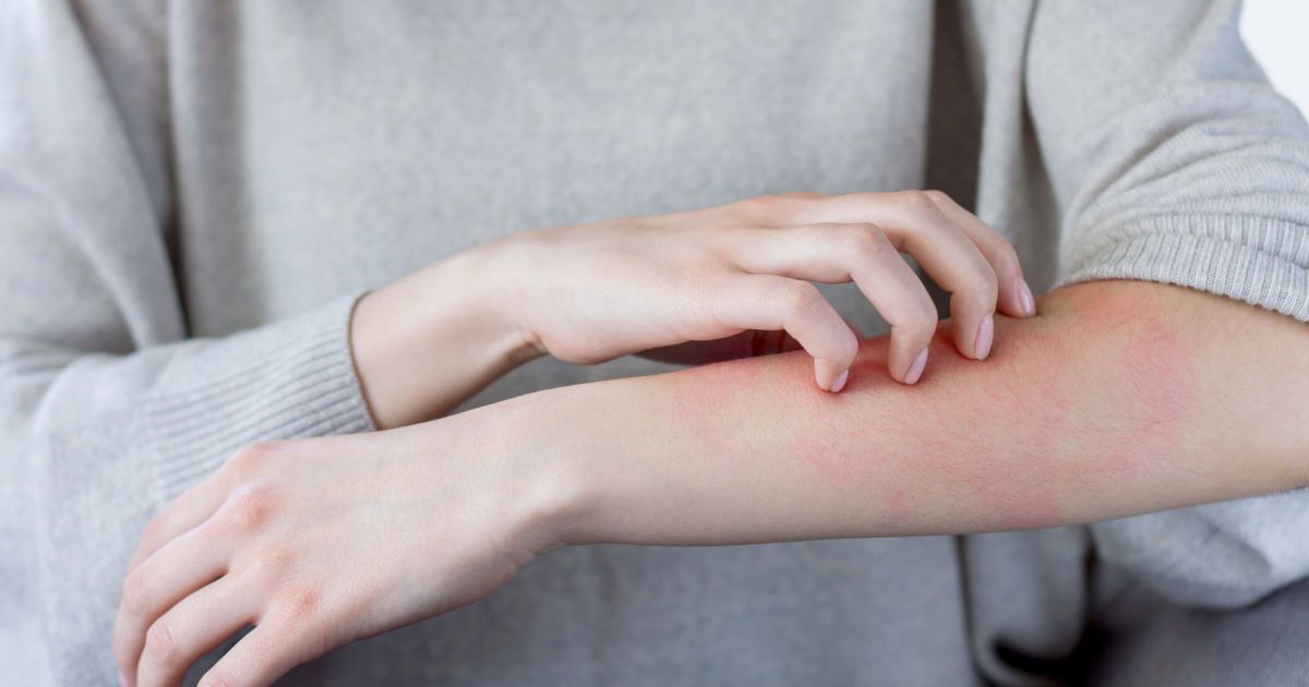 Аллергия на холод: как проявляется, симптомы, лечение — EVO Laboratoires